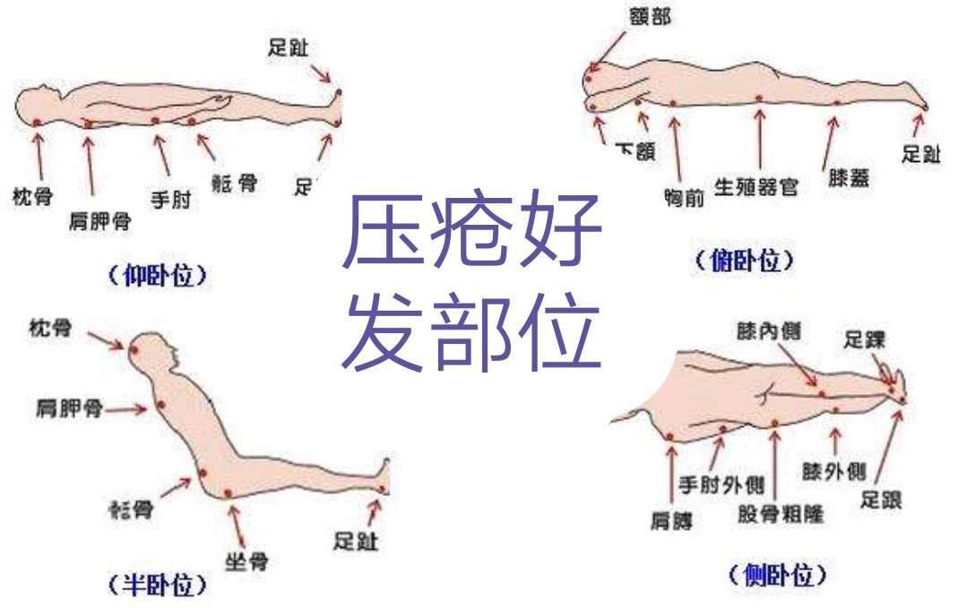 壓瘡分期與護(hù)理方法解析