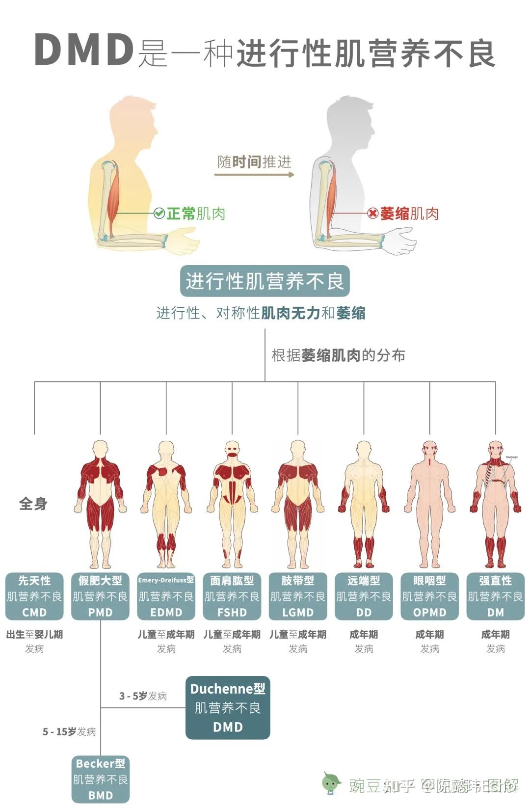 肌營養不良藥物治療最新進展研究概述